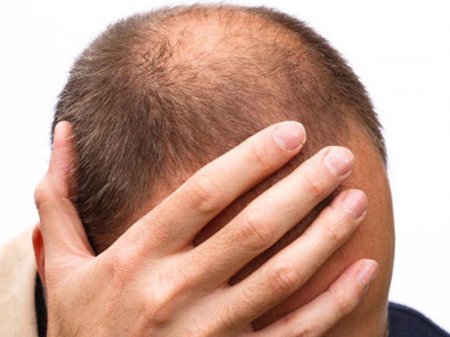 Saç tökülməsini dayandıran EFFEKTİV YOLLAR