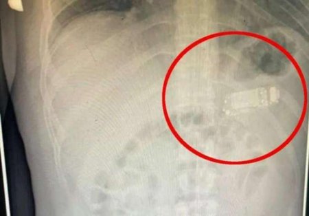 Həkimlər 33 yaşlı şəxsi rentgen aparatına saldılar: ŞOK OLDULAR - FOTOLAR