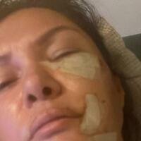 Müğənni itin hücumuna məruz qaldı və üzünə tikişlər vuruldu - FOTO