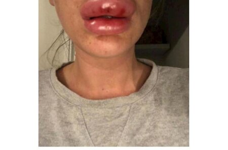 Dodağını şişirtdi başına iş gəldi