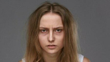 Göz altındakı qara dairələr bu səbəbdən yaranır