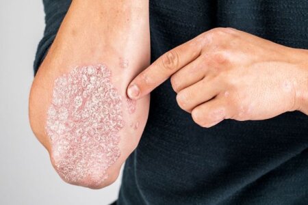 Alimlər psoriazın potensial səbəbini TAPDILAR