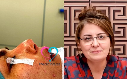 Daha bir estetik əməliyyat faciəsi - Baş həkim həmkarının burnunu tanınmaz hala saldı - FOTO