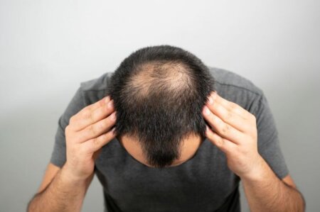Saç tökülməsini dayandırmaq üçün 6 təbii VASİTƏ