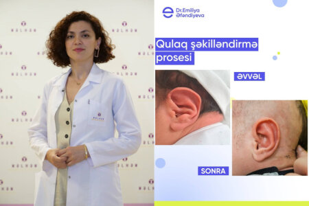 Qulaq şəkilləndirməSİNİN əməliyyatsız müalicəsi