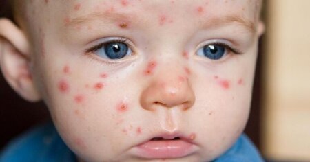 Uşaqlar arasında suçiçəyi xəstəliyi yayılıb - VİDEO